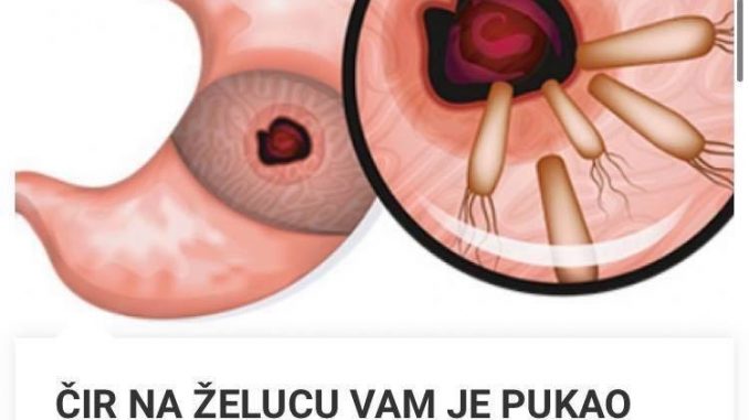 Cir Na Zelucu Vam Je Pukao Ako Se Jave Ovi Simptomi Ni Slucajno Ne Ignorisite Ako Primijetite Ovo Brze U Bolnicu Svi Recepti Su Za 5